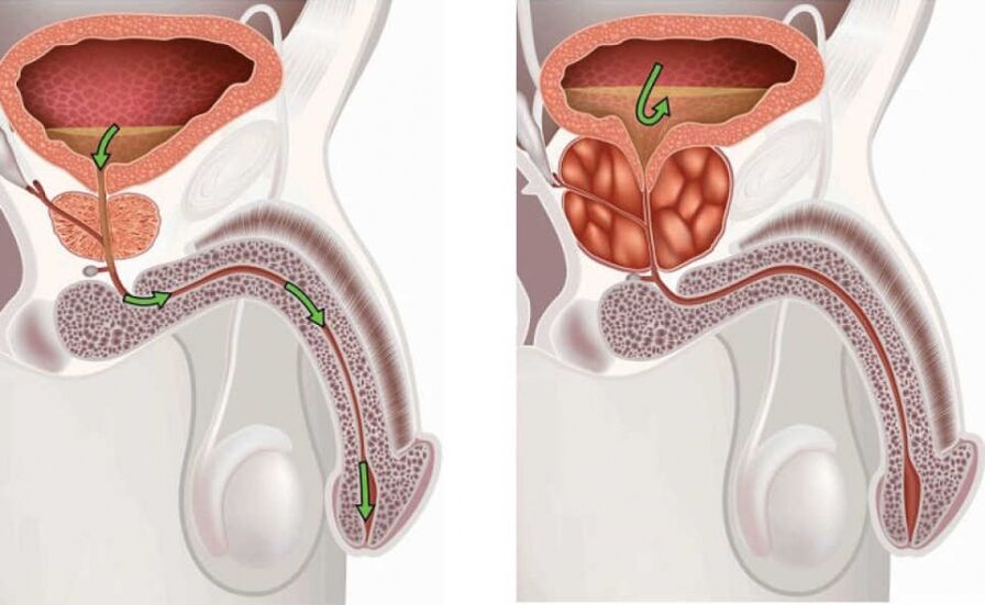 Informacije o bolesti prostatitis