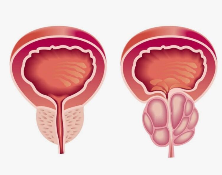 zdrave i bolesne prostate